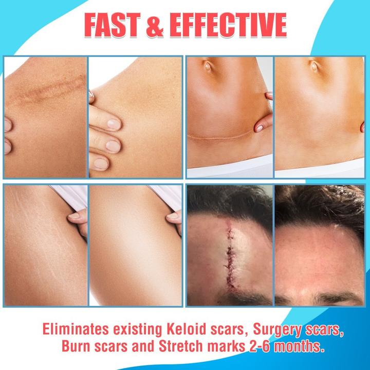 Korean Scar Remover Silicon Gel Patch [Authentic]